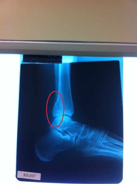 Name:  X-ray of right foot.JPG
Views: 984
Size:  53.9 KB