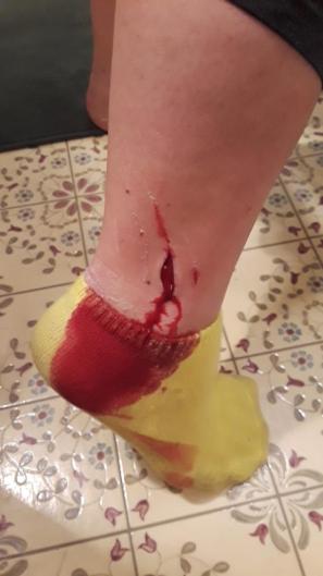 Name:  Owie.jpg
Views: 255
Size:  19.9 KB